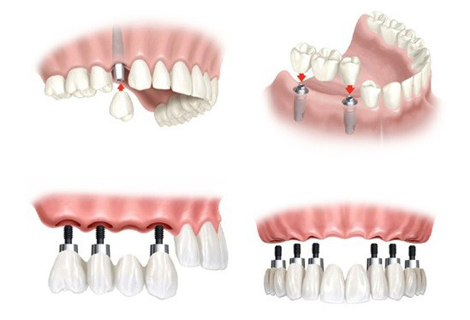 Trồng răng implant tại quận 10